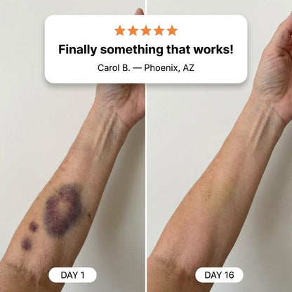 ⭐ Trusted by 100,000+ Customers – Quietqi Bruise Recovery Cream